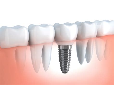 Conheça quais são tipos de implantes dentários Coife Odonto