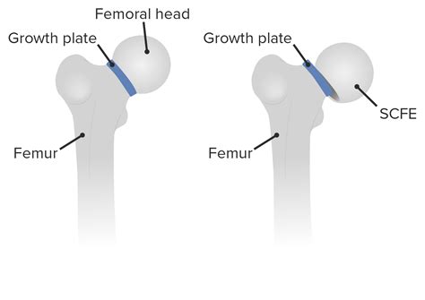 Slipped Capital Femoral Epiphysis Concise Medical Knowledge