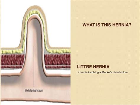 Hernias By Mhr Corp