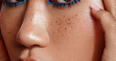 10 Ways To Get Rid Of Freckles