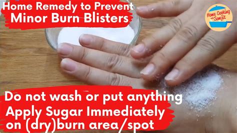 Home Remedy To Prevent Minor Burn Blisters Apply Sugar Immediately Hot Water Oil Splash Hot