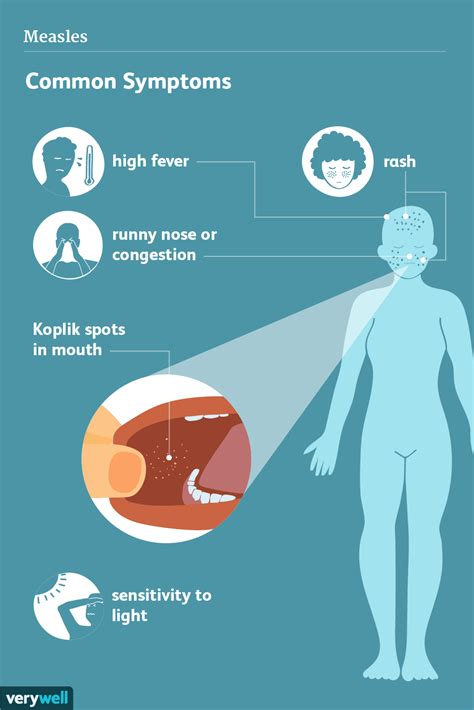 Measles Signs Symptoms And Complications