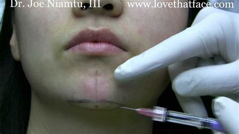 Filler Augmentation Of Chin By Dr Joe Niamtu Iii Youtube