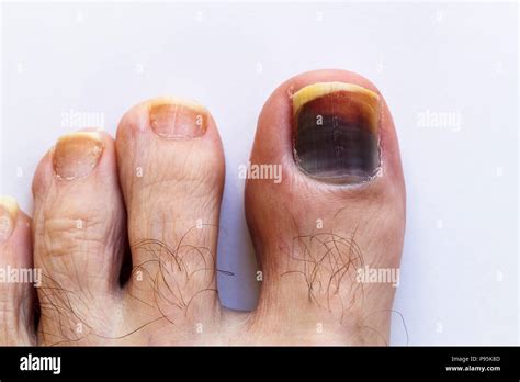 Darkened Bruised Big Toe Hallux Toenail On The Foot Of A Caucasian