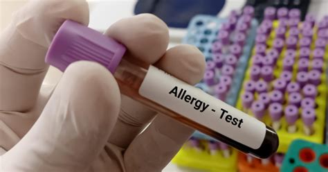 Allergy Test Singapore 101 All Your Common Questions About Allergy