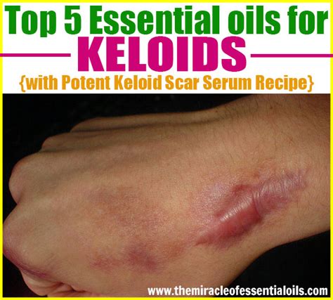 Top 5 Essential Oils For Keloids And How To Use The Miracle Of