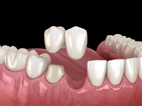 Dental Bridges Bayview Dental Claremont Perth