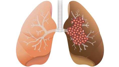 Mooci Bronchialkarzinom So Entsteht Lungenkrebs