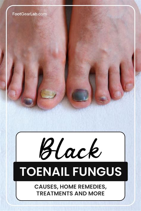 Black Toenail Fungus Causes Home Remedies Treatments And More In