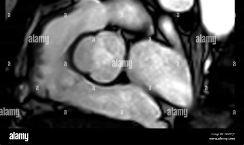 Mri Heart Or Cardiac Mri Magnetic Resonance Imaging Of Heart