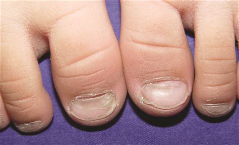 Fingernail Problems Separating Nail Bed Home Design Ideas