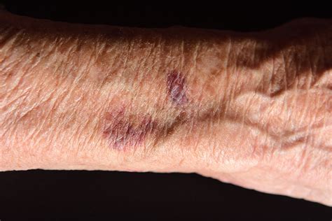 Bruising In The Elderly What Causes Skin Bruising In Seniors