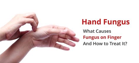 Fungus On Fingers Hand Fungus Causes Symptoms Treatments