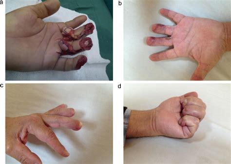 Reconstruction Of Multiple Fingertip Injuries With Reverse Flow