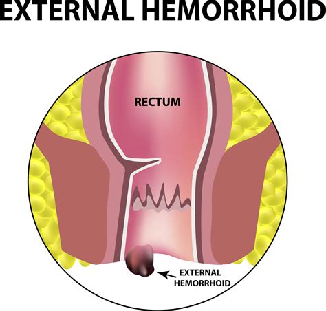 Hemorrhoid Removal Contemporary Health Center