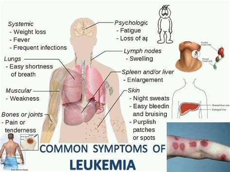 They can appear suddenly in a few days or weeks. 62 best leukemia/ lymphoma images on Pinterest