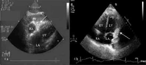 Echocardiogram Of A Patient With Cardiac Tamponade Echocardiogram My Xxx Hot Girl