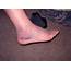Swollen Ankles  Treatment Pictures Pregnancy Symptoms Causes
