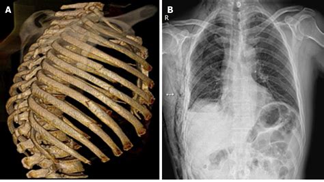Surgical Treatment Ofpatients With Severe Non Flail Chest Rib Fractures