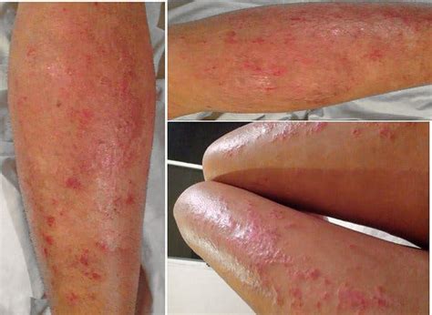 New Drug For Severe Eczema Is Successful In 2 New Trials The New York