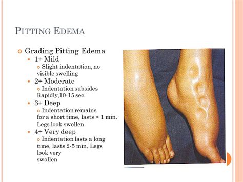 Pitting Edema Scale 1 4 The Image Kid