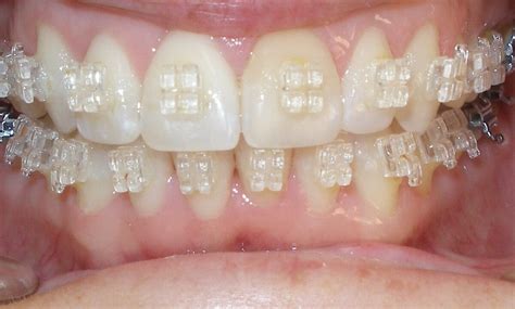 Adult Clear Braces Arroyo Grande California Poole Orthodontics
