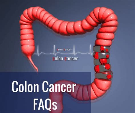 Colorectal Cancer Article Causenta Cancer Treatment Center In
