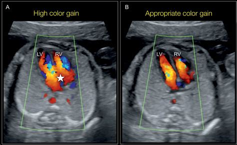 Color Doppler In Fetal Echocardiography Obgyn Key