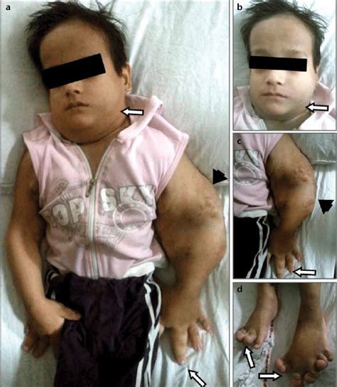A D A Six Year Old Non Asian Indian Boy With Proteus Syndrome