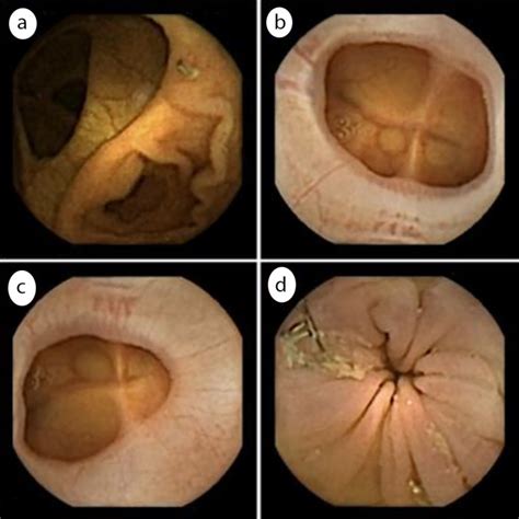 Role of bowel preparation on colocolonic anastomosis: Capsule Endoscopy Versus Colonoscopy in Patients With ...