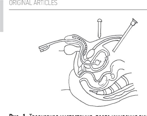 Figure 1 From Features Of The Installation Of A Suprapubic Cystostomy