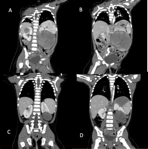 Nephron Sparing Approach For Familial Bilateral Synchronous Wilms