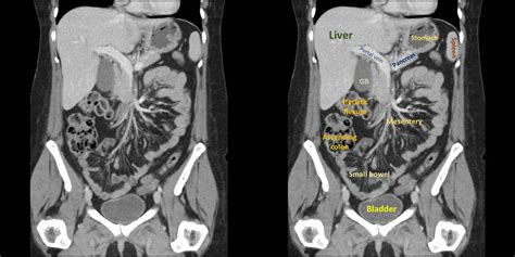 Radiology Basics Abdomen Anatomy