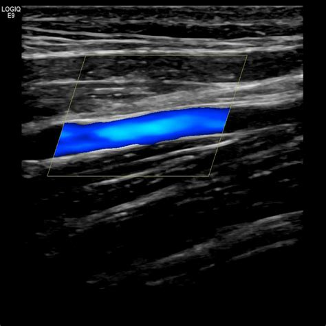 Upper Extremity Venous Doppler Sonographic Tendencies Vascular Ultrasound Vein Thrombosis