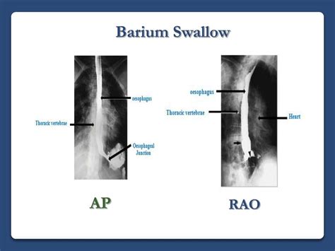 Definition Of Barium Swallow Barium Swallow Medlineplus Medical Test