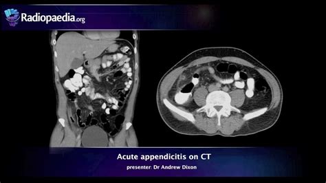 Acute Appendicitis On Ct Radiology Video Tutorial Youtube