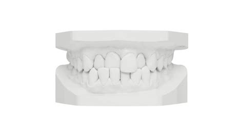 Clear Aligners Dentist Harlow