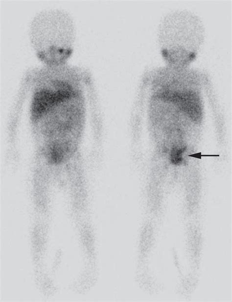 Mibg In Neuroblastoma Diagnostic Imaging And Therapy Radiographics