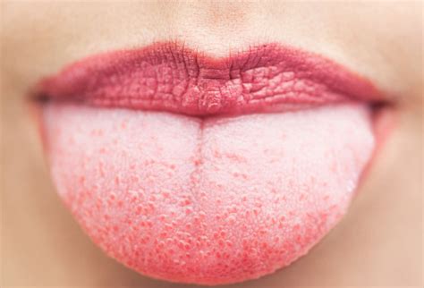 What Causes The White Coating On Your Tongue Centre Dentaire St Laurent
