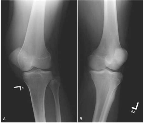 Medial Oblique Knee X Ray