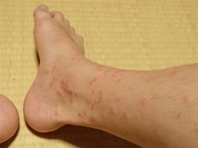 Maybe you would like to learn more about one of these? 【写真付】子供の虫刺され!種類と症状 画像で見る虫刺され跡 ...