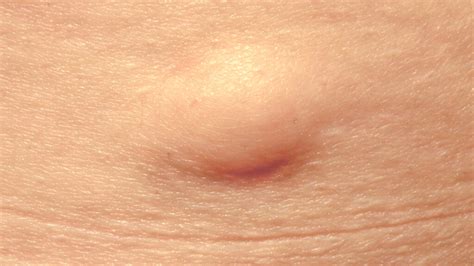Underarm Cyst Causes Pictures Painful Sebaceous