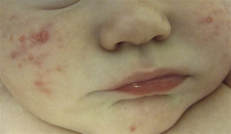 Pediatric Acne Dermatologic Clinics