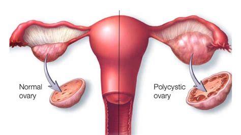 polycystic ovary syndrome pcos cause symptoms and treatment