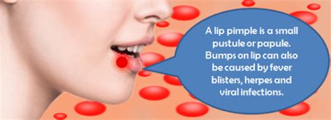 How To Get Rid Of Pimple On Lip Best Remedies For Bump On Lip