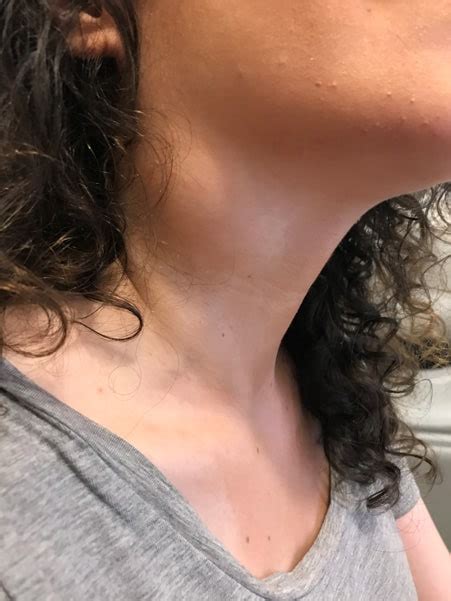 Throat Cancer Lump On Outside Of Neck