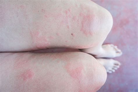 Can Stress Cause Hives What To Know About Stress Rashes