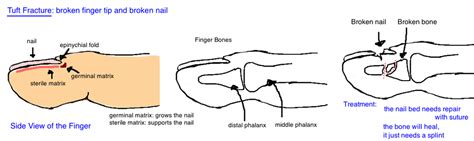 Nailbed Injury & Broken Finger Tip — Bone Talks