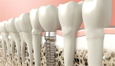 Breve historia del implante dental Mima Clínica Dental