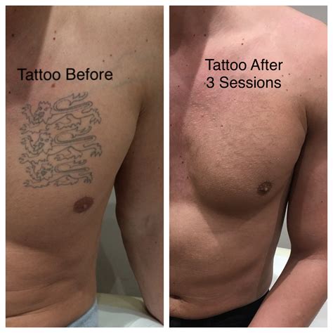 Tattoo Removal